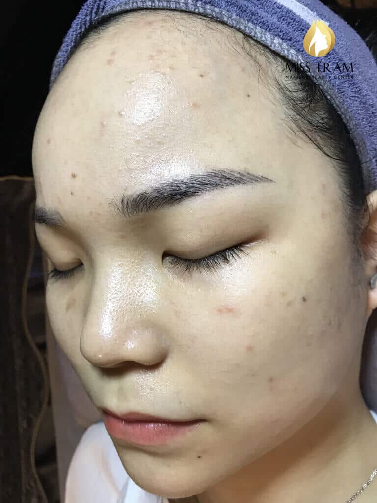 Before And After Acne Skin Treatment - Tighten Pores And Whiten Skin 7