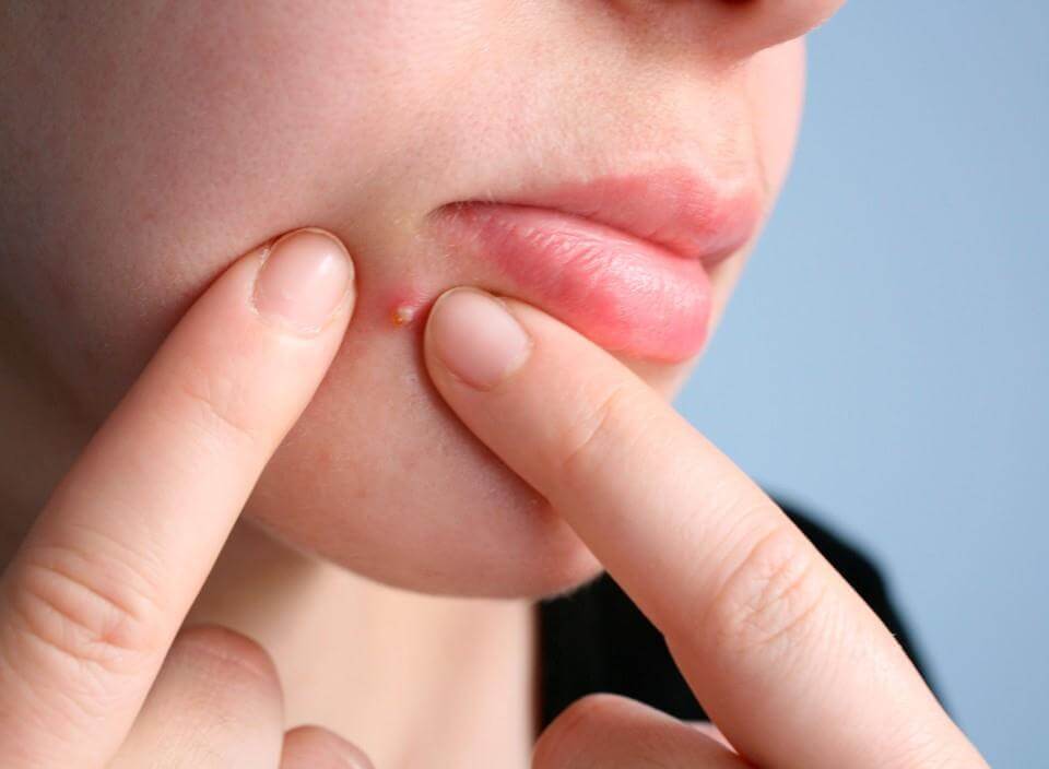 Tips to reduce swelling after squeezing acne