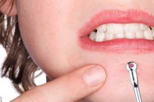The Secret to Reducing Swelling After Squeezing Acne From Nature 8