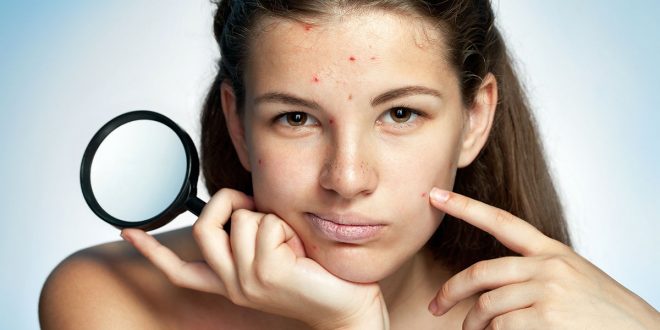 Skin Care Process After Popping Acne 1