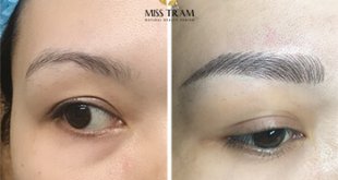 Before And After The Results Of Eyebrow Sculpting Are Different For A Smaller Eyebrow Shape Compared To The Face 31