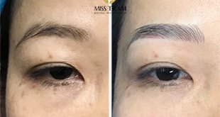 Before And After Eyebrow Lifting - Beautiful Eyebrow Sculpture For Women 15