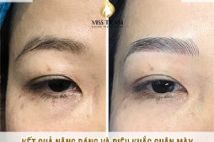 Before And After Eyebrow Lifting - Beautiful Eyebrow Sculpture For Women 51