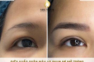 Before And After Eyebrow Sculpting And Eyelid Spray 41