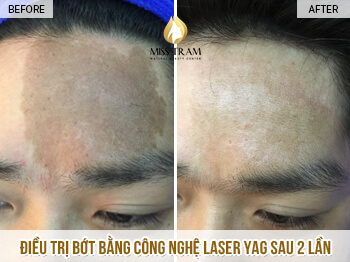 Before And After The Results Of Mark Removal With Yag Laser Technology 4