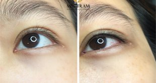 Before And After The Results Of Eyelid Spray For Women 1