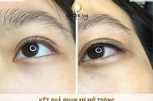 Before And After The Results Of Eyelid Spray For Women 7