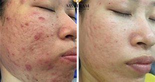 Before And After Treating Acne Skin And Improving Scars At Spa 1
