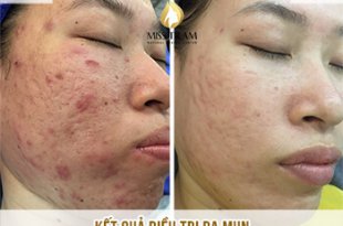 Trước Và Sau Điều Trị Da Mụn Và Cải Thiện Sẹo Rỗ Tại Spa 11