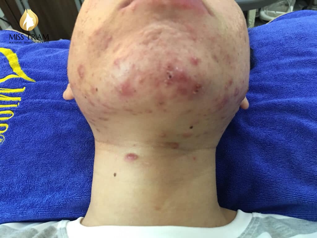 Before And After Treating Acne Skin And Improving Scars At Spa 9
