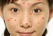 Acne Location Alerts Your Health Status 8