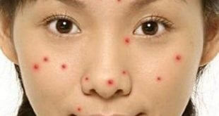 Acne Location Alerts Your Health Status 3