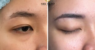 Before And After Using Eyebrow Sculpting Technology For Women 16