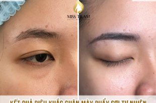 Before And After Using Eyebrow Sculpting Technology For Women 57