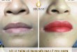 Before And After The Results Of Deep Treatment And Collagen Lip Spray 23