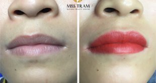 Before And After The Results Of Deep Treatment And Collagen Lip Spray 1