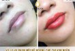 Before And After Treatment - Super Beautiful Queen Lip Spray For Women 7