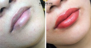 Before And After Treatment - Super Beautiful Queen Lip Spray For Women 19
