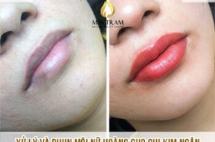 Before And After Treatment - Super Beautiful Queen Lip Spray For Women 33