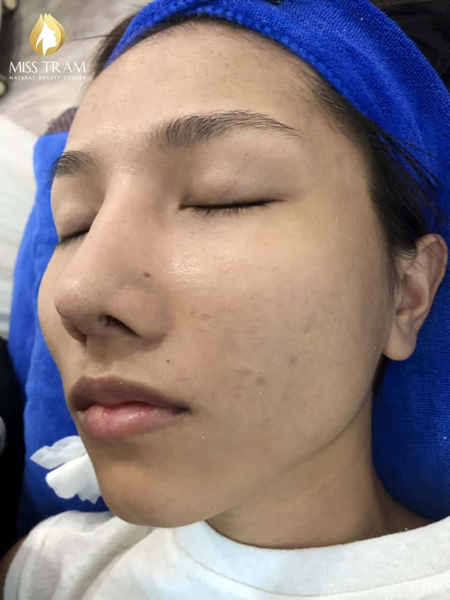 Before And After Improving Brightness And Beautifying Skin At Spa 6