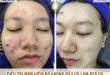 Before And After Treatment Of Headless Inflammatory Red Acne And Skin Beauty 4