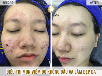 Trước Và Sau Điều Trị Mụn Đỏ Viêm Không Đầu Và Làm Đẹp Da 6