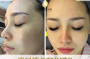 Before And After Treating Acne Hidden Under The Skin With Rom For Women 7