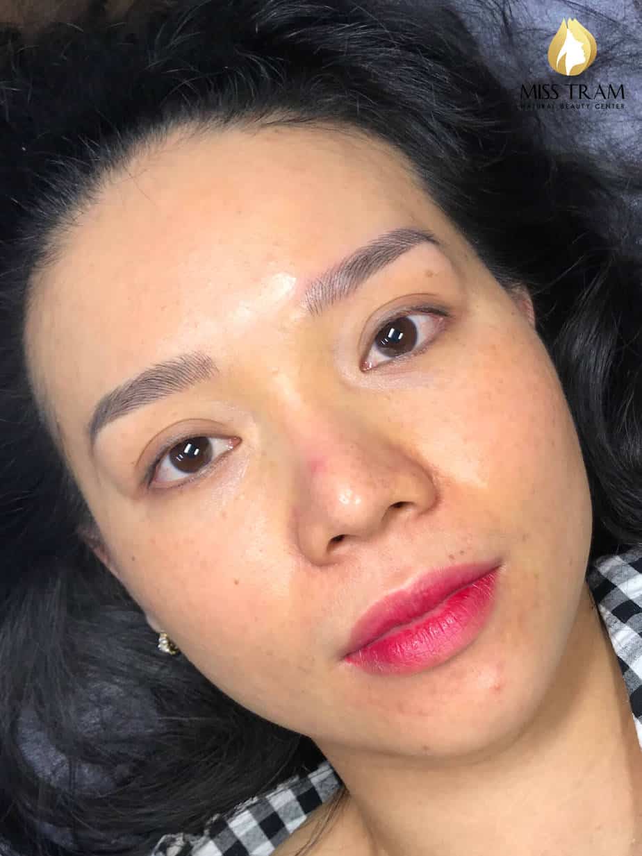 Before And After Covering Eyebrow Scars With 9 . Thread Sculpting Method