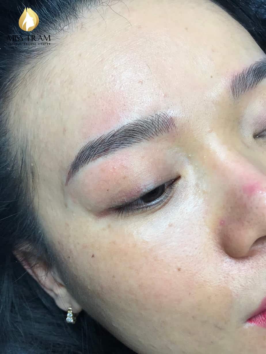 Before And After Covering Eyebrow Scars With 8 . Thread Sculpting Method