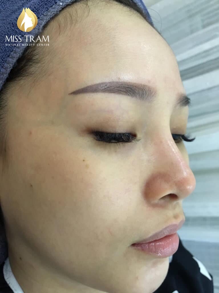 Before And After Treating Acne Hidden Under The Skin With Rom For Women 8