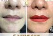 Before And After Darkening Treatment And Spraying Beauty Queen's Lips 20