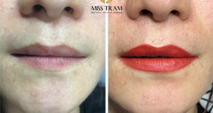 Before And After Darkening Treatment And Spraying Beauty Queen's Lips 10