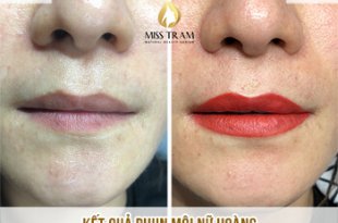 Before And After Darkening Treatment And Spraying Beauty Queen's Lips 30