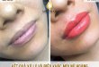 Before And After Sculpting Super Beautiful Queen Lips 1