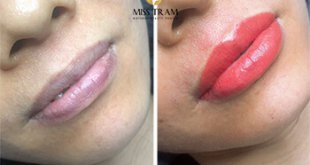 Before And After Sculpting Super Beautiful Queen Lips 1