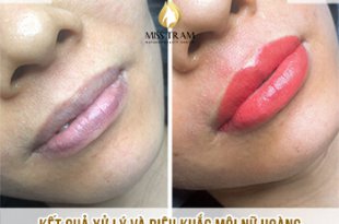 Before And After Sculpting Super Beautiful Queen Lips 31