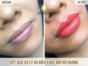 Before And After Sculpting Super Beautiful Queen Lips 4