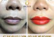 Before And After Treating And Sculpting Beautiful Queen Lips 21