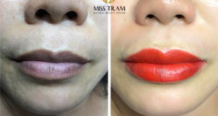 Before And After Treating And Sculpting Beautiful Queen Lips 2