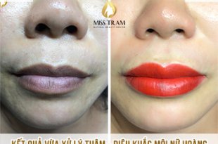 Before And After Treating And Sculpting Beautiful Queen Lips 14