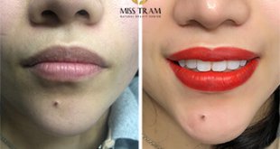 Before And After Deep Treatment - Queen Lip Sculpting For Women 1