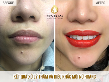 Trước Và Sau Xử Lý Thâm - Điêu Khắc Môi Nữ Hoàng Cho Nữ 3