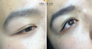 Before And After "Impressive" Water Eyelid Spray At Spa 3