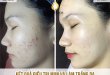 Before And After Using Acne Treatment And Whitening Technology 8