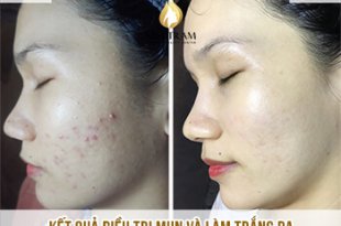 Before And After Using Acne Treatment And Whitening Technology 18