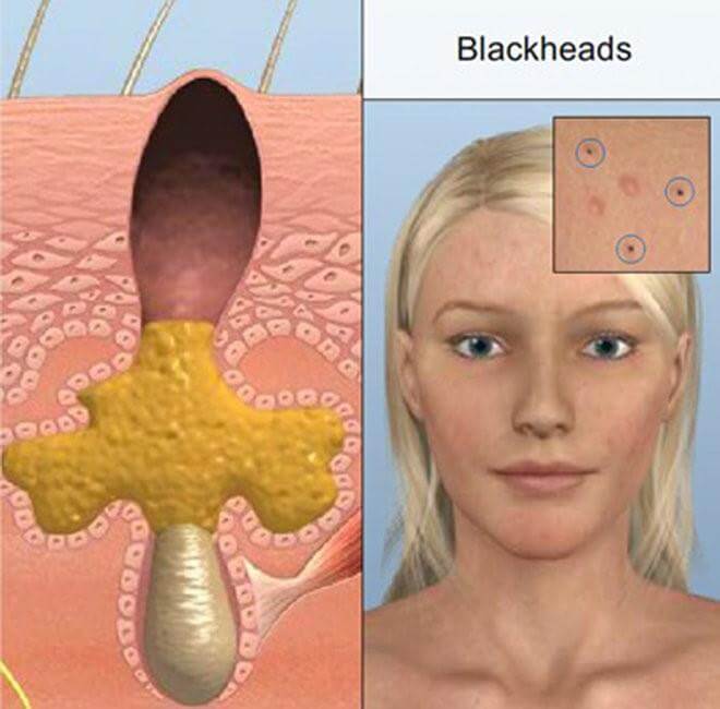 What causes blackheads?