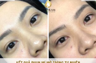 Before And After Actual Image Spraying Natural Eyelids 11