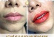 Before And After The Queen's Lip Sculpting Method 9
