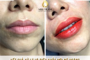 Before And After The Queen's Lip Sculpting Method 7