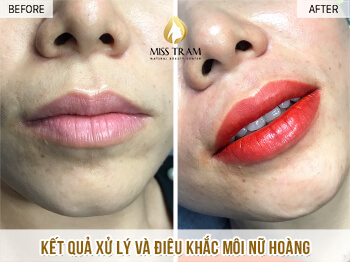 Before And After The Queen's Lip Sculpting Method 3